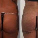 Rimodellamento Glutei Milano Roma