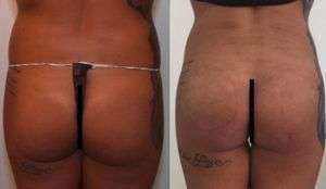 Rimodellamento Glutei Milano Roma