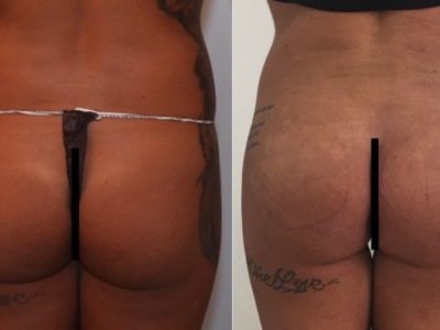 Rimodellamento Glutei Milano Roma