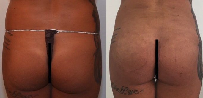 Rimodellamento Glutei Milano Roma