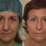 Ultherapy fotografie casi clinici