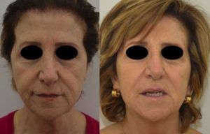 Ultherapy ultrasuoni focalizzati