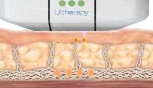 Offerta Ultherapy Roma