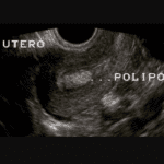 POLIPI UTERINI