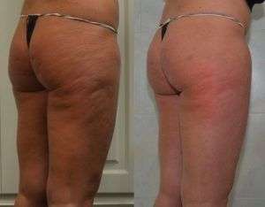 Trattamento della Cellulite con Cellfina nella provincia di Monza Brianza