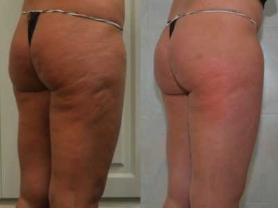 Trattamento della Cellulite con Cellfina nella provincia di Monza Brianza