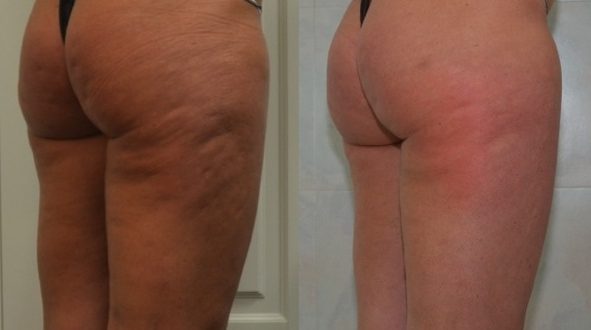 Trattamento della Cellulite con Cellfina nella provincia di Monza Brianza