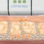 Ultherapy Monza Brianza