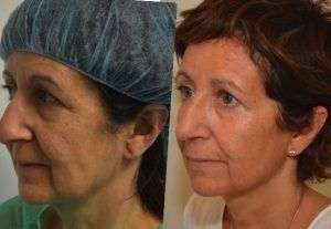 Ultherapy Monza Brianza