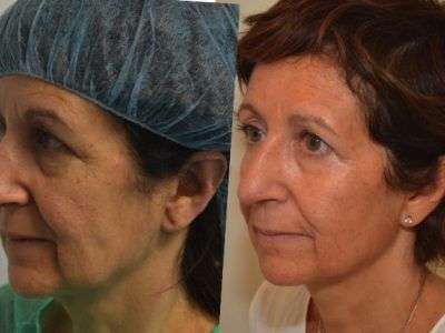 Ultherapy Monza Brianza