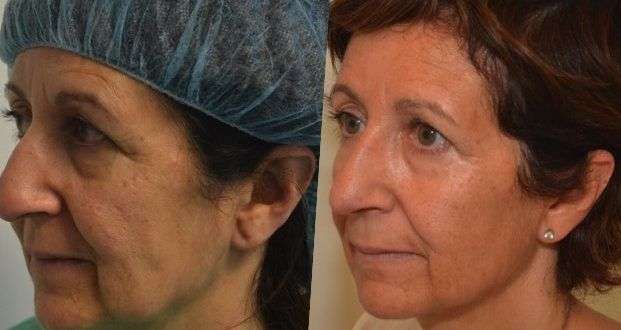 Ultherapy Monza Brianza