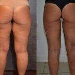 Stanca dei buchi della cellulite