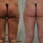 Stanca dei buchi della cellulite