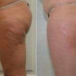 Stanca dei buchi della cellulite