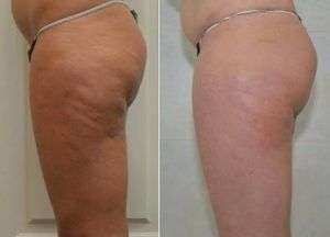 Stanca dei buchi della cellulite