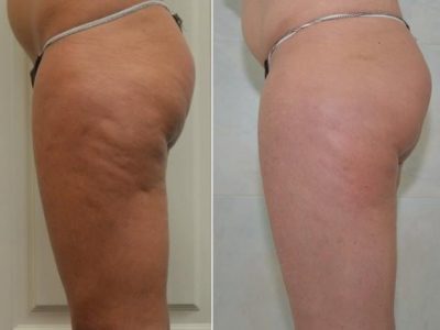 Stanca dei buchi della cellulite