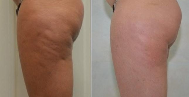 Stanca dei buchi della cellulite