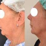 Ultrasuoni focalizzati Ultherapy