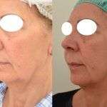 Ultrasuoni focalizzati Ultherapy