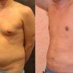 Liposcultura Monza &#8211; Risultati