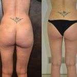 Liposcultura Monza &#8211; Risultati