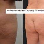 Associazione Cellfina lipofilling per rimodellamento glutei