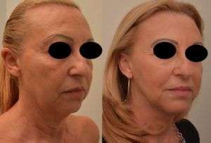 Ultherapy Roma - Ultrasuoni focalizzati