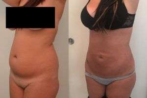 Liposuzione non invasiva Roma