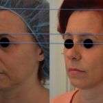 Ultherapy e Radiesse