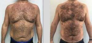 Liposuzione laser o Crioterapia