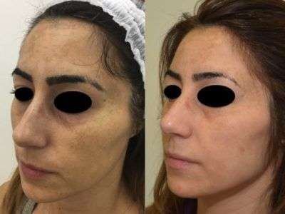 Trattamento Melasma a Milano. Il prof. Antonino Araco, direttore medico e scientifico dei centri Jenevì Medical è specializzato nel Trattamento del Melasma. Infatti, ha sviluppato un protocollo di trattamento personalizzato che prevede la combinazione di un trattamento ambulatoriale e un trattamento domiciliare. Innanzitutto, c’è da evidenziare che il Melasma è una vera e propria malattia della pelle e che la diagnosi deve essere precisa. E solo dopo una accurata visita medica che prevede anche l’utilizzo di tecnologie di analisi computerizzate della pelle, quali ANTERA 3d, può essere ben caratterizzata. Poiché ci sono differenti tipologie di macchie del volto, solo una diagnosi precisa potrà garantire il massimo del risultato estetico. Infatti, nel volto le macchie possono essere suddivise in macchie da sole, macchie da senescenza e appunto macchie da Melasma. Queste ultime sono di grandi dimensioni e si localizzano esclusivamente in una o più aree del volto. Pertanto, il trattamento è molto complesso perché è necessario agire nel derma in profondità. Inoltre, non possono essere utilizzate tecnologie laser poiché i melanociti possono attivarsi e quindi peggiorare la situazione clinica. Infine per l’alta percentuale di recidiva di malattia appena ci si espone al sole. Il prof. Araco propone pertanto un trattamento combinato: peeling ambulatoriale a base di TCA e trattamento domiciliare di mantenimento. Tra i peeling ambulatoriali, molto efficace è il c.d. Blue Peeling che consiste in un peeling al Tca al 20% unito ad una base chimica che rende la pelle della paziente blue. Se desideri ricevere maggiori informazioni sul Trattamento Melasma a Milano, chiama la segreteria unica al n. 067012470 o scrivi a medici@jenevi.it Trattamento Melasma a Milano.