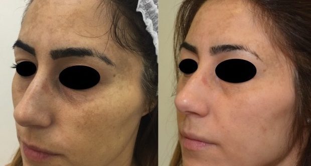 Trattamento Melasma a Milano. Il prof. Antonino Araco, direttore medico e scientifico dei centri Jenevì Medical è specializzato nel Trattamento del Melasma. Infatti, ha sviluppato un protocollo di trattamento personalizzato che prevede la combinazione di un trattamento ambulatoriale e un trattamento domiciliare. Innanzitutto, c’è da evidenziare che il Melasma è una vera e propria malattia della pelle e che la diagnosi deve essere precisa. E solo dopo una accurata visita medica che prevede anche l’utilizzo di tecnologie di analisi computerizzate della pelle, quali ANTERA 3d, può essere ben caratterizzata. Poiché ci sono differenti tipologie di macchie del volto, solo una diagnosi precisa potrà garantire il massimo del risultato estetico. Infatti, nel volto le macchie possono essere suddivise in macchie da sole, macchie da senescenza e appunto macchie da Melasma. Queste ultime sono di grandi dimensioni e si localizzano esclusivamente in una o più aree del volto. Pertanto, il trattamento è molto complesso perché è necessario agire nel derma in profondità. Inoltre, non possono essere utilizzate tecnologie laser poiché i melanociti possono attivarsi e quindi peggiorare la situazione clinica. Infine per l’alta percentuale di recidiva di malattia appena ci si espone al sole. Il prof. Araco propone pertanto un trattamento combinato: peeling ambulatoriale a base di TCA e trattamento domiciliare di mantenimento. Tra i peeling ambulatoriali, molto efficace è il c.d. Blue Peeling che consiste in un peeling al Tca al 20% unito ad una base chimica che rende la pelle della paziente blue. Se desideri ricevere maggiori informazioni sul Trattamento Melasma a Milano, chiama la segreteria unica al n. 067012470 o scrivi a medici@jenevi.it Trattamento Melasma a Milano.