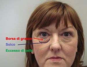 Complicanza da filler nella regione orbitaria &#8211; come evitarla?