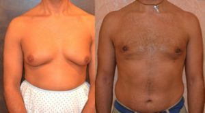 Ginecomastia - trattamento con liposcultura toracica e mastectomia sottocutanea 