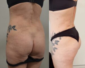 Rimodellamento dei glutei – tecniche combinate di chirurgia plastica estetica