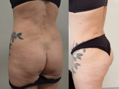 Rimodellamento dei glutei – tecniche combinate di chirurgia plastica estetica