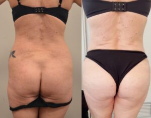 Rimodellamento dei glutei – tecniche combinate di chirurgia plastica estetica