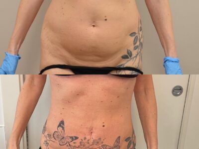 Associazione di Criolipolisi, Endolift laser e Body-Sculp