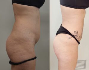 Rimodellamento dei glutei – tecniche combinate di chirurgia plastica estetica