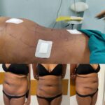 AcquaLipo – La liposcultura gentile approvata dalla scienza