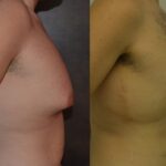 AcquaLipo – La liposcultura gentile approvata dalla scienza