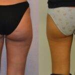 AcquaLipo – La liposcultura gentile approvata dalla scienza