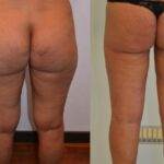 AcquaLipo – La liposcultura gentile approvata dalla scienza