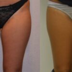 AcquaLipo – La liposcultura gentile approvata dalla scienza