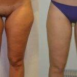 AcquaLipo – La liposcultura gentile approvata dalla scienza