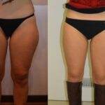 AcquaLipo – La liposcultura gentile approvata dalla scienza