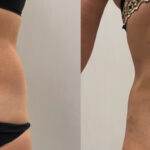 AcquaLipo – La liposcultura gentile approvata dalla scienza