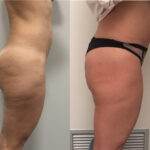 AcquaLipo – La liposcultura gentile approvata dalla scienza