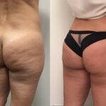 AcquaLipo – La liposcultura gentile approvata dalla scienza