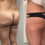 AcquaLipo – La liposcultura gentile approvata dalla scienza